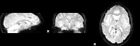 fmri